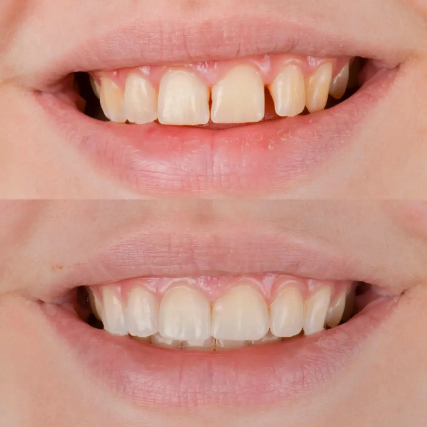 Procedimiento dental