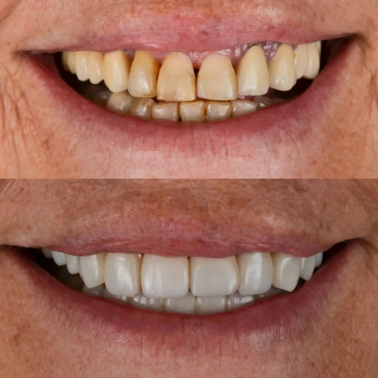 Procedimiento dental