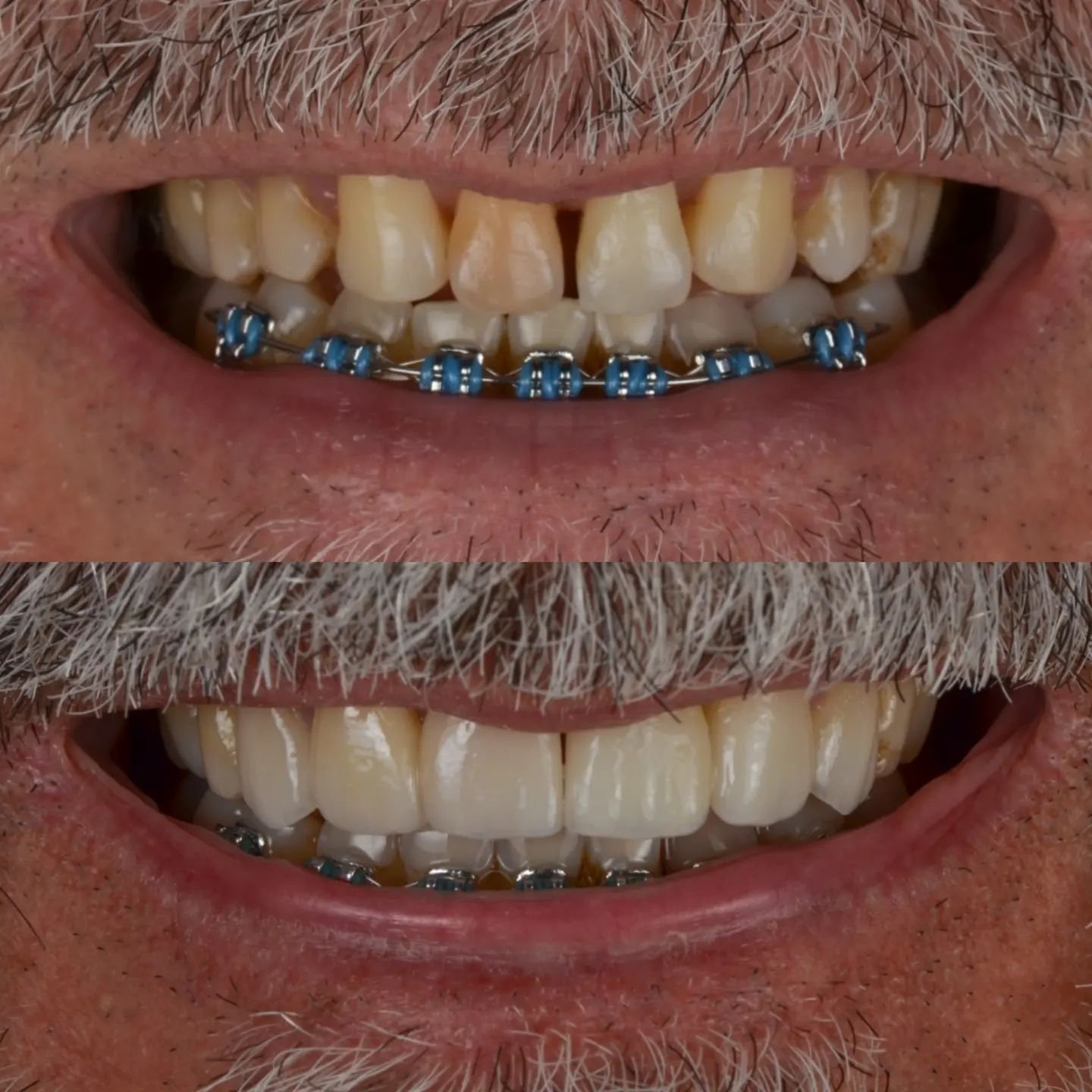Tratamiento con carillas ceramicas